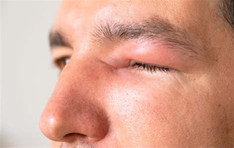 swollen eyelids      rid