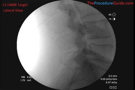 Fluoroscopic Guided Lumbar Medial Branch Block (LMBB) - Technique and ...