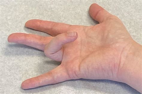 Trigger Finger: New Braunfels Orthopaedic Surgery & Sports Medicine
