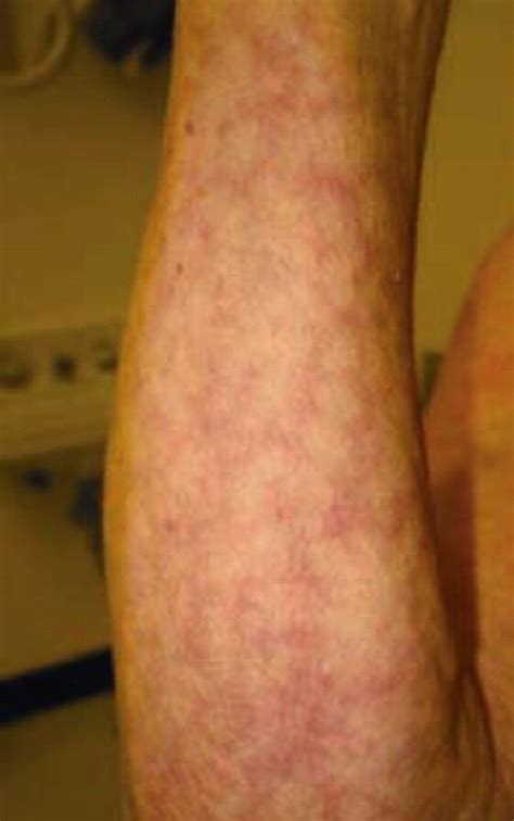 Livedo reticularis | Livedo reticularis, Health, Healthy living