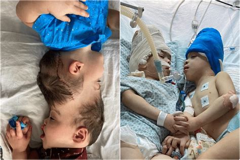 Conjoined twins separated with help of virtual reality in Brazil | The ...