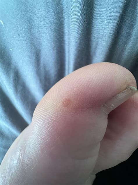 Red dot? Wart vs Callus vs ??? : r/Dermatology