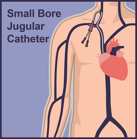 Central Venous Catheter Lines | Vascular Wellness