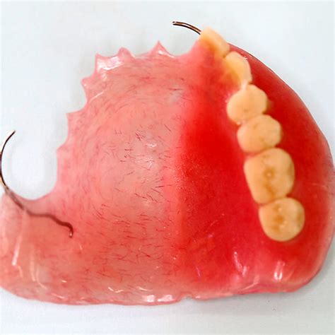 Temporary obturator -palatal view | Download Scientific Diagram