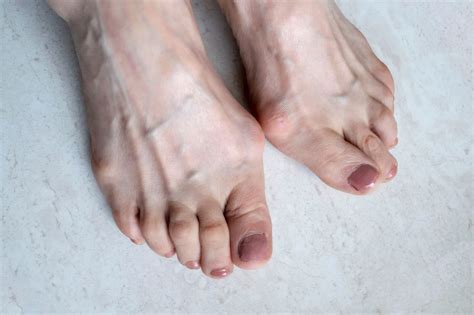 Hallux Rigidus for Philadelphia, PA | Frankford Podiatry Associates, PC ...