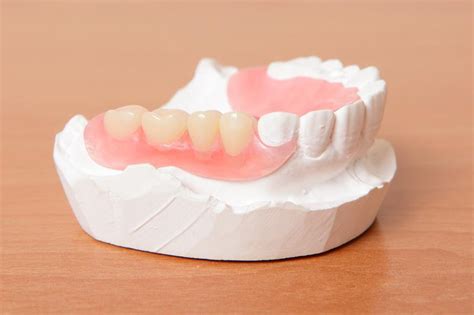 how to remove flexible partial dentures - Lottie Means