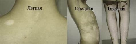 Берут ли в армию с витилиго? Новости 2018