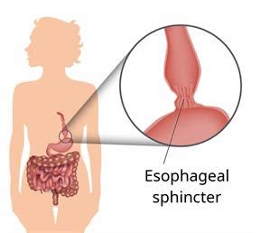 Elsevier – Patient Education │Laparoscopic Heller Myotomy