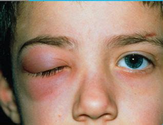 Preseptal Cellulitis Vs Orbital Cellulitis