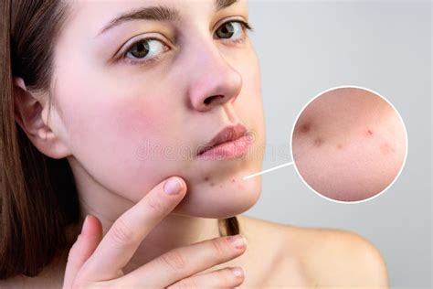 young woman  problematic face skin   gray background stock