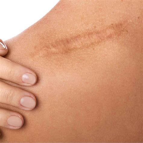 Keloid and Hypertrophic Scars