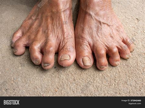 Foot Seniors. Dirty Image & Photo (Free Trial) | Bigstock