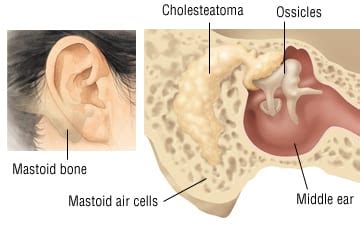 Mastoiditis Symptoms