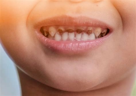 Pediatric Tooth Decay Causes Treatment Prevention Images