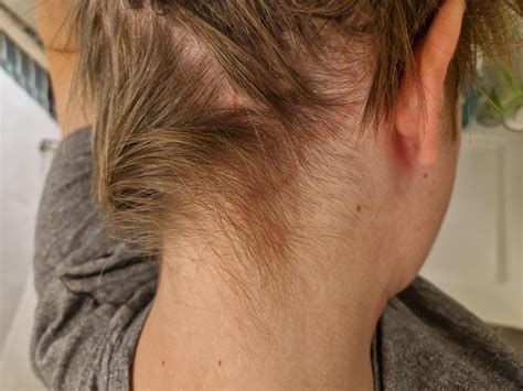 Couls this be seb derm? : r/SebDerm