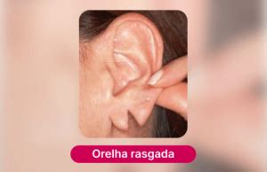 O Que Significa Orelha Seca - Tipos de Orelhas e Suas Deformidades | Doutor Orelhinha