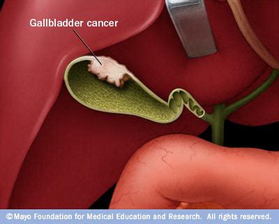 Signs and Symptoms of Gallbladder Cancer