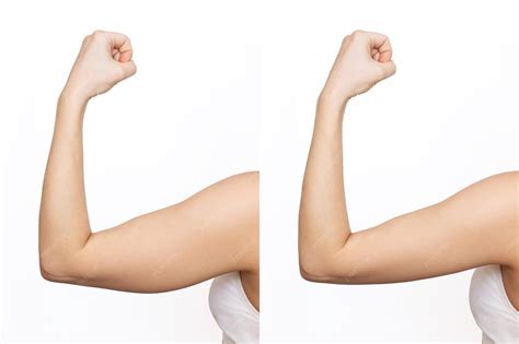Braço Gordo Antes E Depois - Duas fotos de uma jovem com excesso de gordura no braço e braço ...