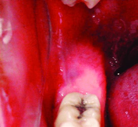intraoral clinical image revealed normal mucosa  scientific