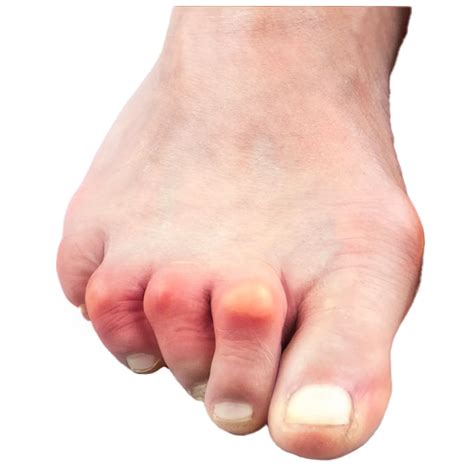 toe deformities dr bothma