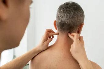 kista epidermoid apotek mandjur