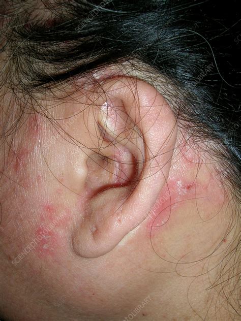 seborrheic dermatitis  rash  denise feliciano blog