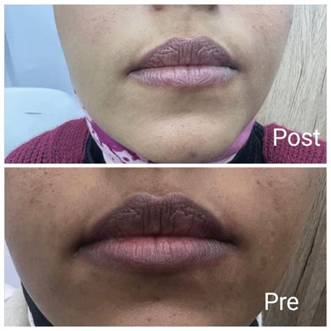 laser lips supply freshness center  dermatology laser