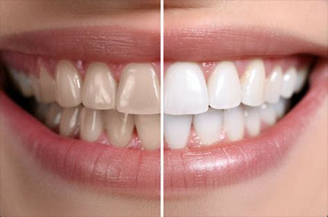 The Impact of an Enhanced Smile on Confidence and Posture - Bridge ...
