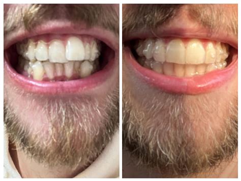 Unlock the Power of Invisalign: Stunning Before and After Photos That Will Leave You Breathless