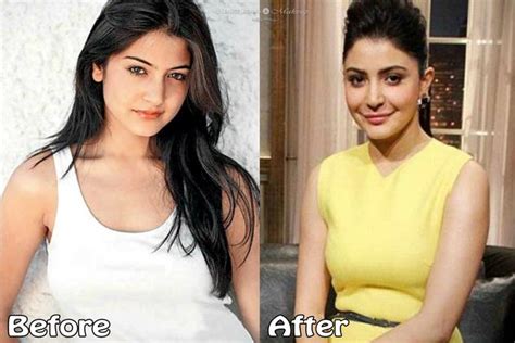 Anushka Sharma Nose Job