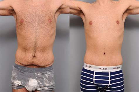 tummy tuck  men  nyc dr thomas sterry