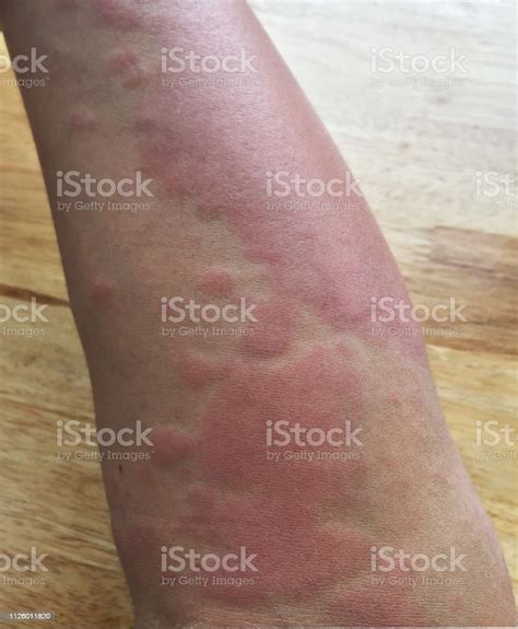 Rash From Bee Sting Hives Rash Stock Photo - Download Image Now ...