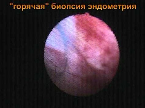 Офисная гистероскопия перед удачной попыткой ЭКО и ПЭ. - YouTube