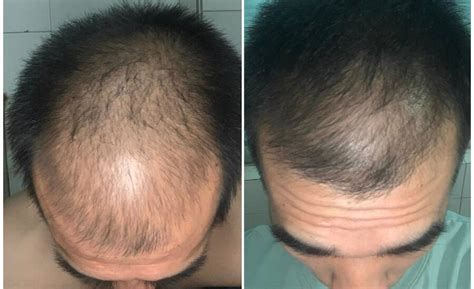 Can Microneedling Help Your Scalp Regrow Hair? – diaminyaesthetics