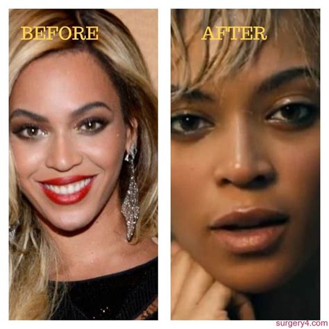 Beyonce Nose Job Photos [Before & After] ⋆ Surgery4