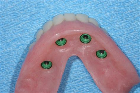 OVERDENTURES - Utica Dental Laboratory