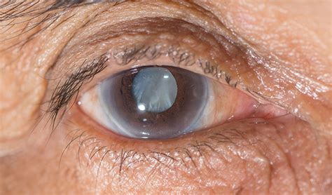 June is Cataract Awareness Month - Bella Eye Care Optometry