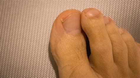 The Ingrown Toenail: Causes, Prevention, and Effective Care - Clinique ...