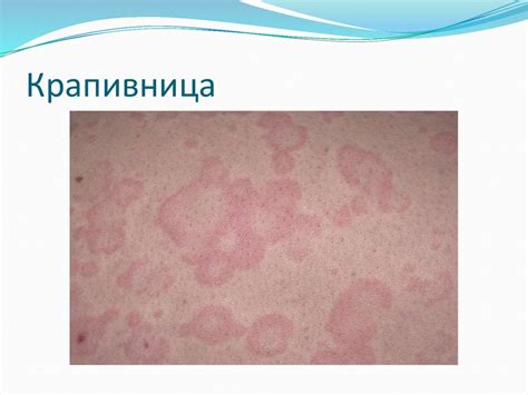 Крапивница - презентация онлайн