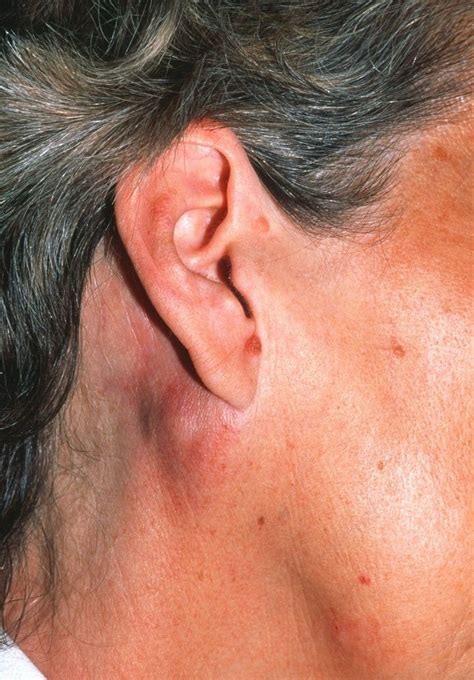 Image:Non-Hodgkin Lymphoma (Posterior Auricular Lymphadenopathy)-Merck