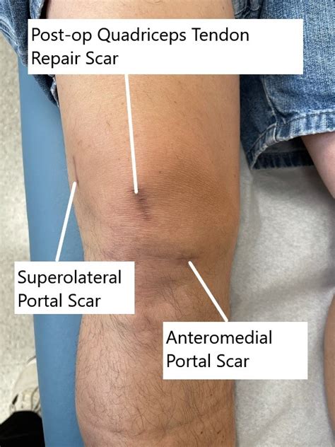 acl surgery allograft  autograft complete orthopedics