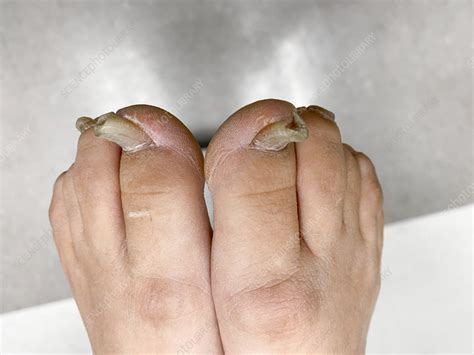 how to fix deformed toenails
