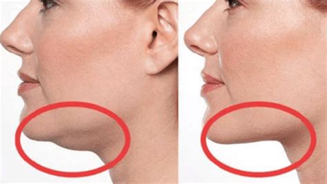 Double Chin Liposuction Hollywood, Florida Surgery and Weight Loss Center