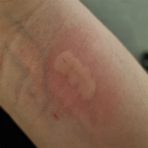 Does this look like an allergic reaction to a cat scratch? It itches a