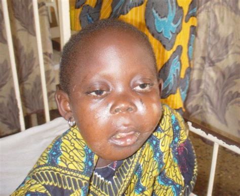 cure  children  burkitt lymphoma  africa globalgiving