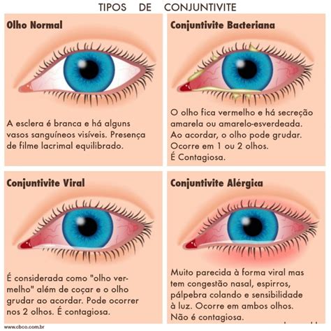 O Que É A Conjuntivite