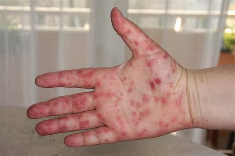 Hand-Foot-and-Mouth Disease on the Rise: Experts Beg Parents to Learn ...
