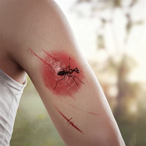 piqure de fourmi   reactions allergiques possibles santemed