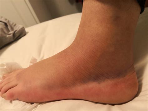 I sprained my ankle, which happens to me often because of bad feet but