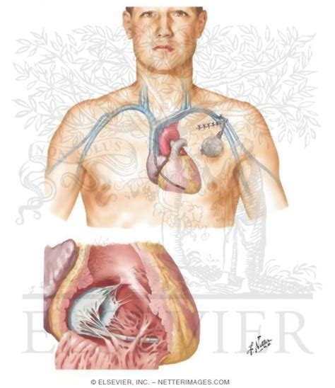 Pacemaker Implantation In Treatment of Complete Heart Block